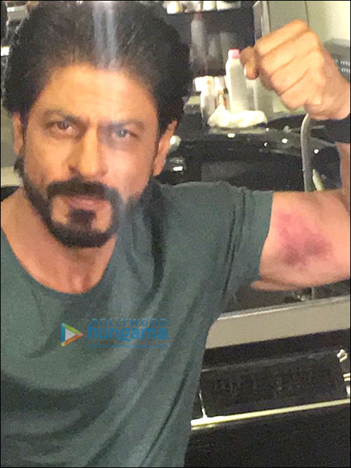 Check out: Shah Rukh Khan flaunts his injury calling it ‘lovebite’