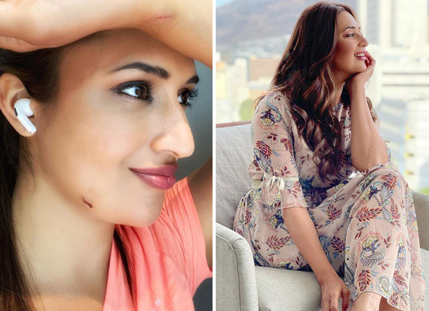 Khatron Ke Khiladi 11 Divyanka Tripathi flaunts crocodile tooth mark on her chin after performing the stunt 