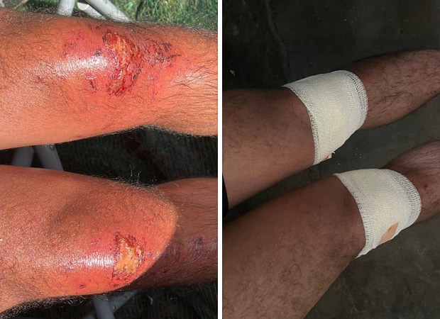 Khatron Ke Khiladi 12: Nishant Bhat suffers major injuries while performing the tasks on the reality show