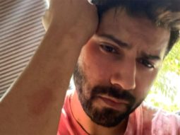 Varun Dhawan shares photo of bruises on his arm on the sets of Citadel India