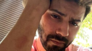 Varun Dhawan shares photo of bruises on his arm on the sets of Citadel India