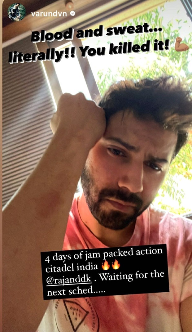 Varun Dhawan shares photo of bruisers on his arm on the sets of Citadel India Varun Dhawan shares photo of bruisers on his arm on the sets of Citadel India
