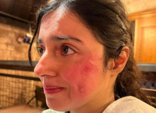 Divya Khosla gets “Badly injured” on sets of her upcoming film; says, “But the show must go on”