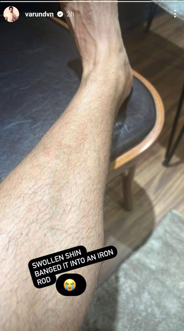 Varun Dhawan injures his leg after banging into an iron rod during Atlee's VD 18 shoot, shares pic