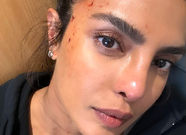 Priyanka Chopra sustains minor injury on the sets of Heads of State; shares bloodied up picture
