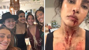 Priyanka Chopra Jonas showcases the ‘glamorous’ side of action as she shares photos of blood and bruise